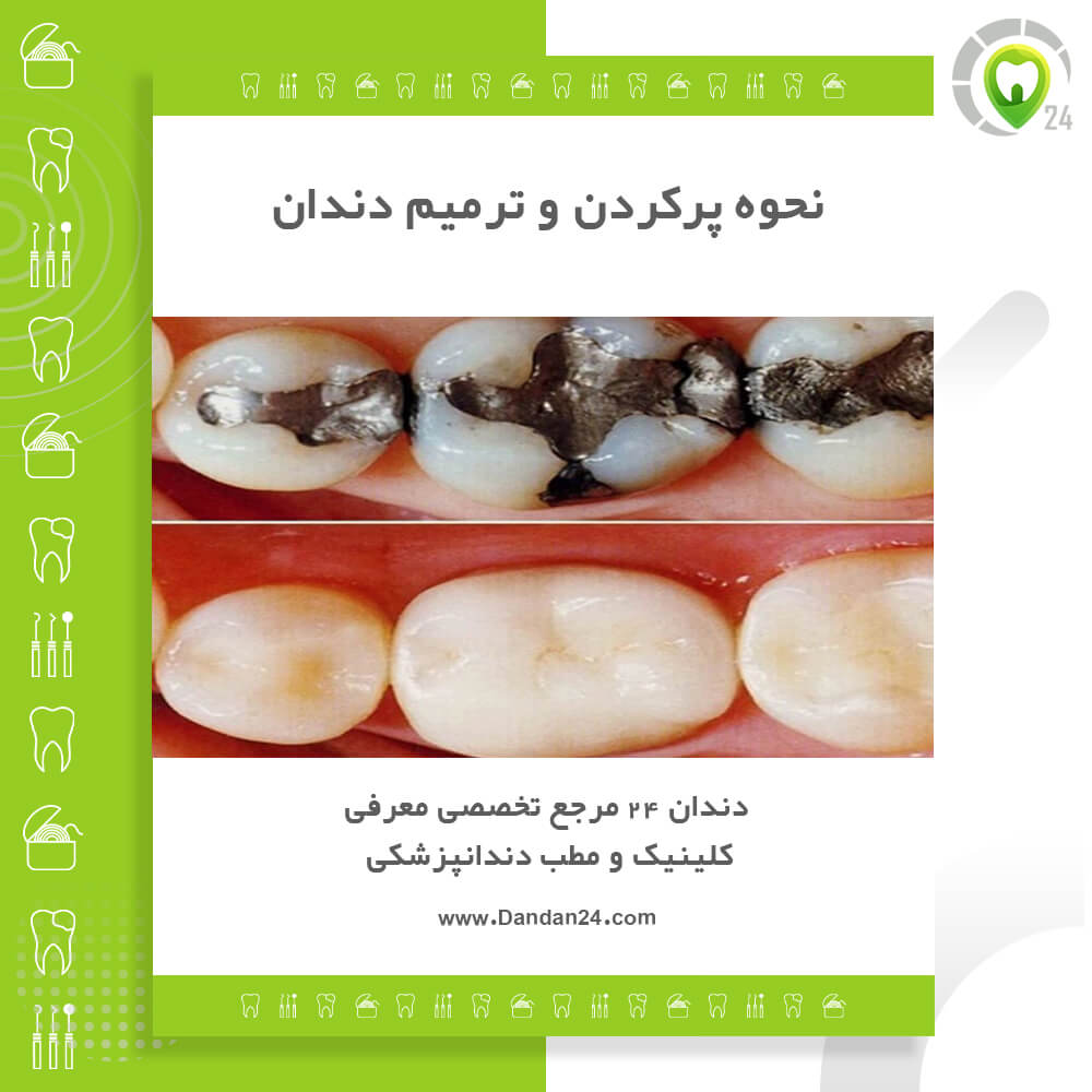 نحوه پر کردن دندان